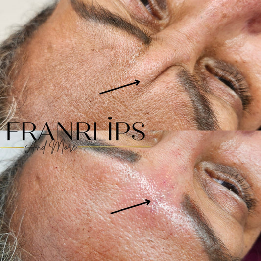 Relleno Facial entrecejo