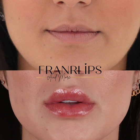 Aumento de Labios (0.5ml)