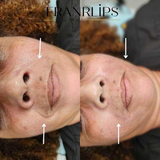 Relleno Facial nasogeniano